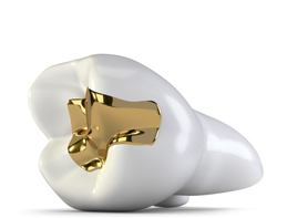 Zahnfüllung aus Gold, Zahnarztpraxis Ruth Hennes